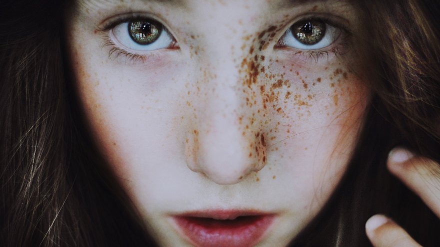 Vibrant eyes and one-sided freckles