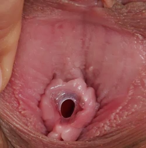 Extreme Closeup of a Girl\ s Hymen Cherry