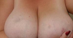 zdjęcie amatorskie My poor bruised cleavage after someone went a bit crazy on them!
