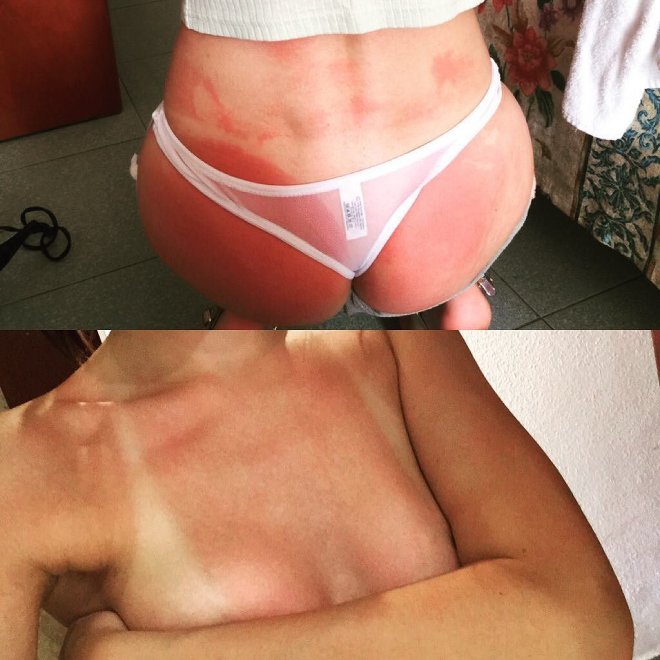 Do burn lines count? First day on holiday