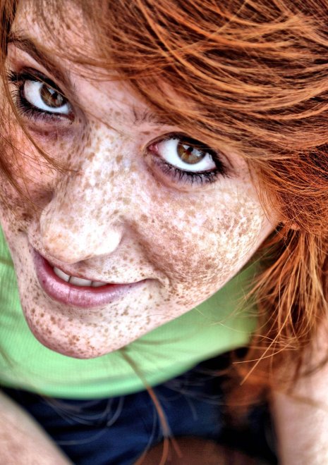 Extreme freckles