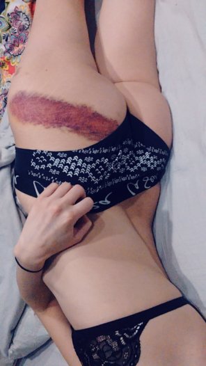 [F] My bruise was so pretty