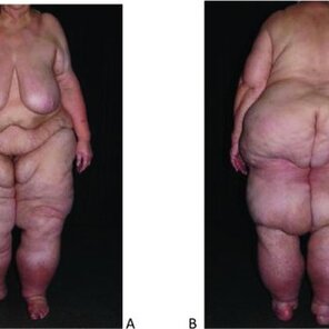 photo amateur Patient-1-with-advanced-lipo-lymphedema-before-liposuction-a-Frontal-view-b_Q320