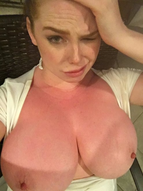 Sophie Coady's sunburnt boobs