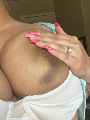 zdjęcie amatorskie When your titties sucked so hard he leaves you bruised ðŸ¤ª