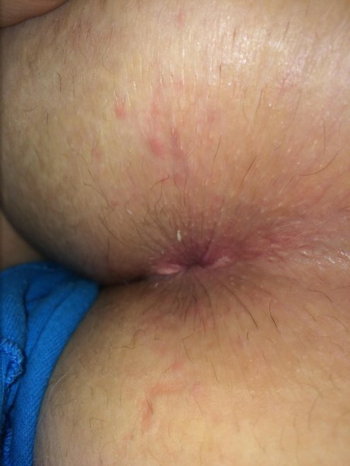 Skin Close Up Flesh Pruritus Porn Pic Eporner