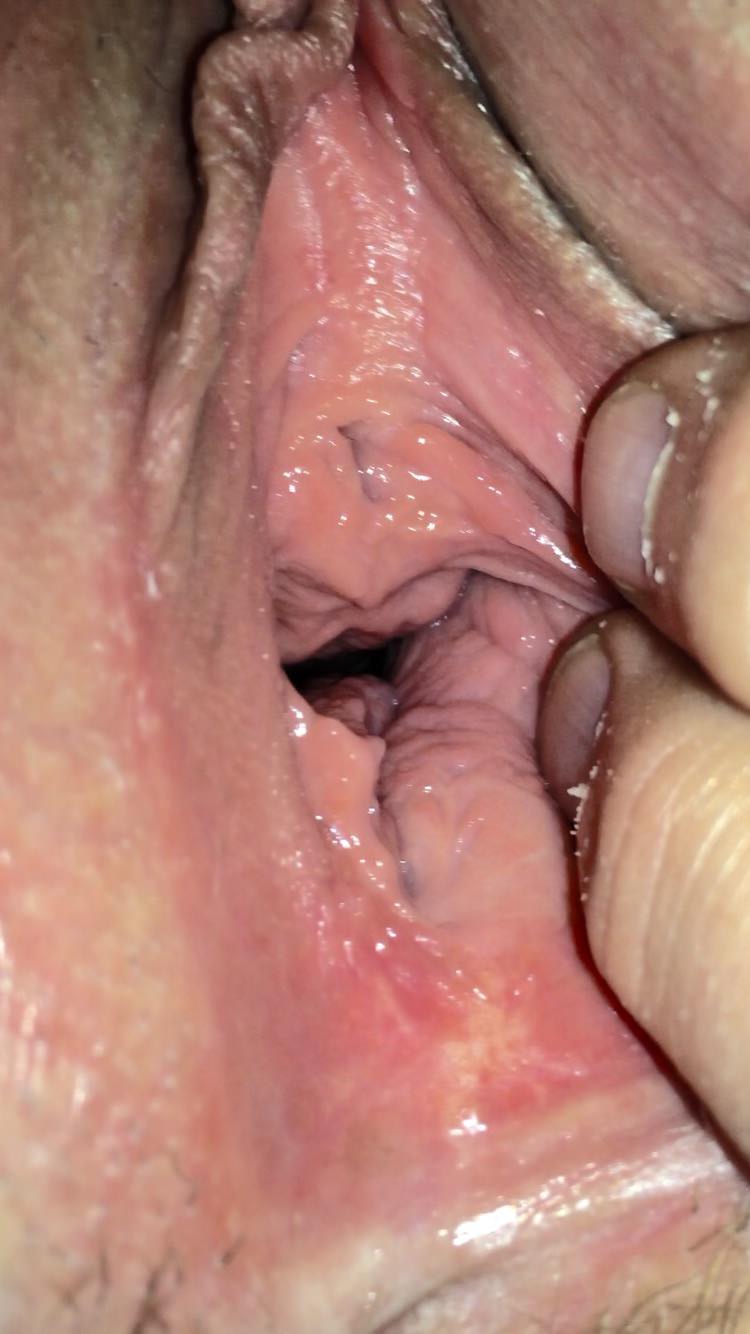 Massive throat bulge