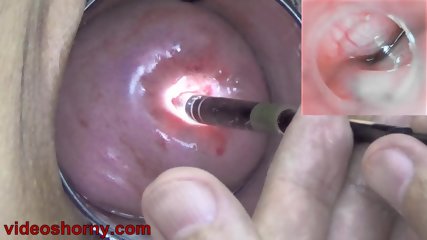 Girl Cervix Playing With Endoscope Japanese Camera Into Uterus