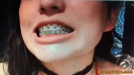 Metalic Teeth